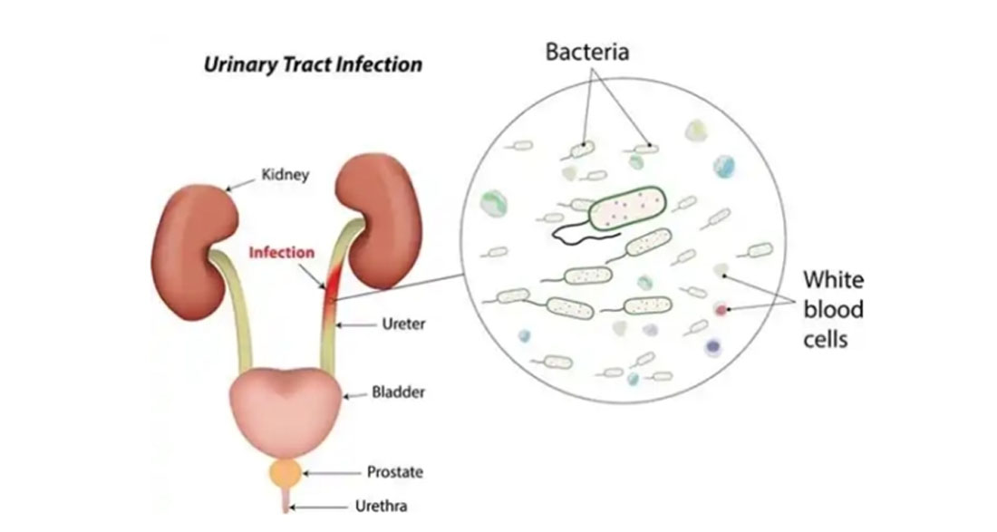 If you want to clean your urinary track and prevent kidney problems, eat these 5 foods regularly