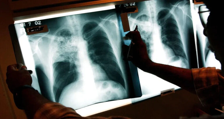 Kansas Tuberculosis Outbreak, Largest in US History, Hits 67 Active Cases Across Two Counties – Latest Details